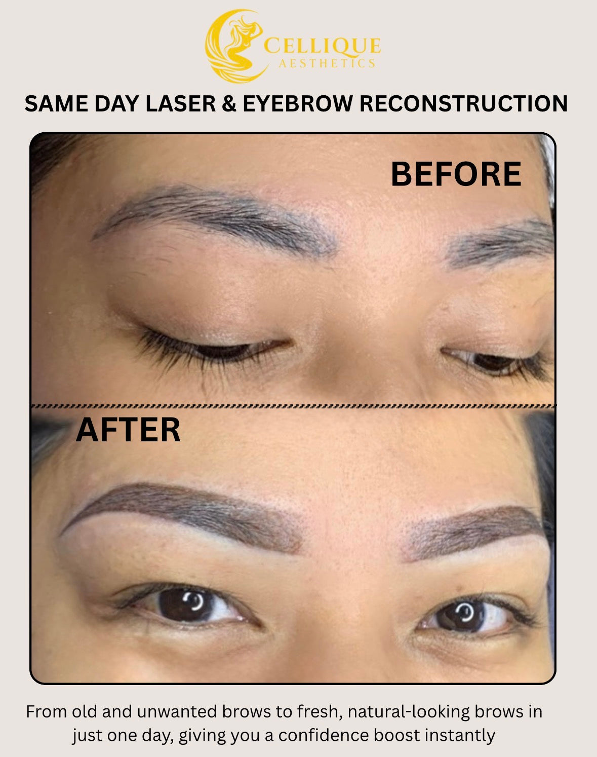 Same Day Laser and Brow Reconstruction