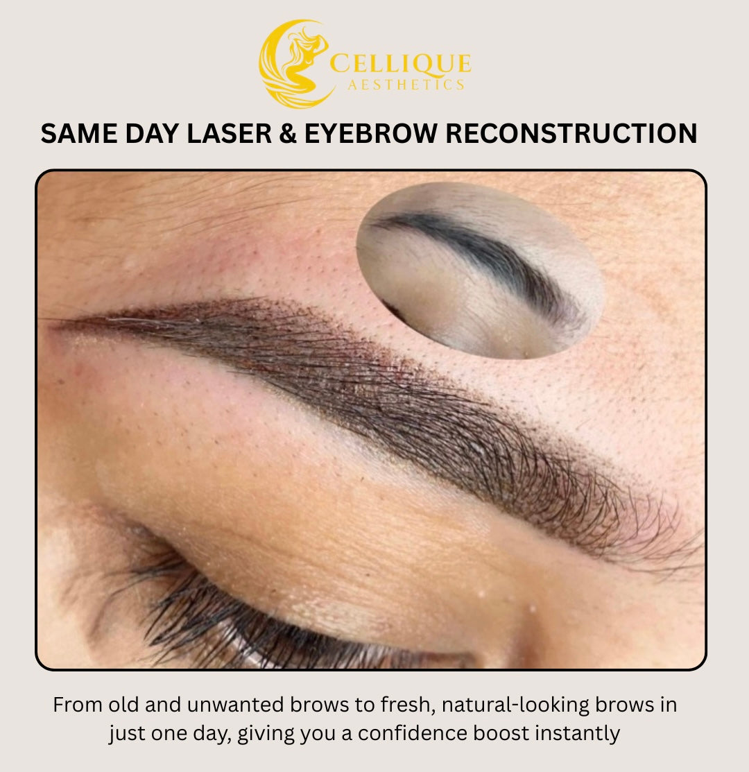 Same Day Laser and Brow Reconstruction