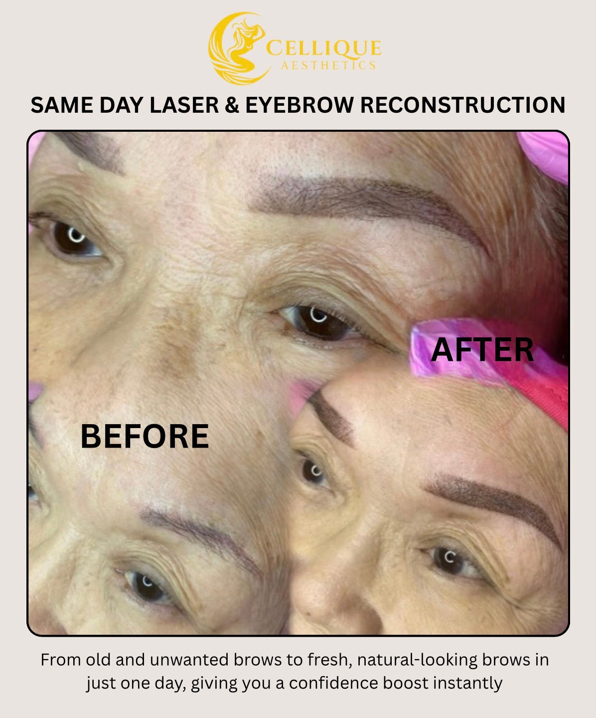 Same Day Laser and Brow Reconstruction