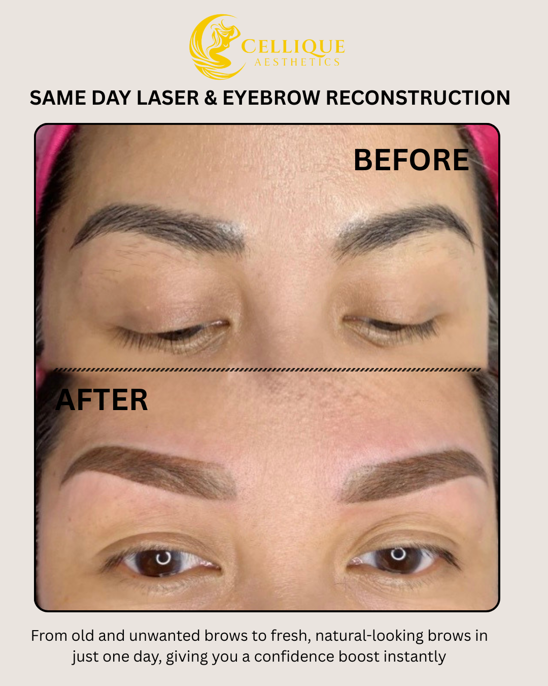 Same Day Laser and Brow Reconstruction