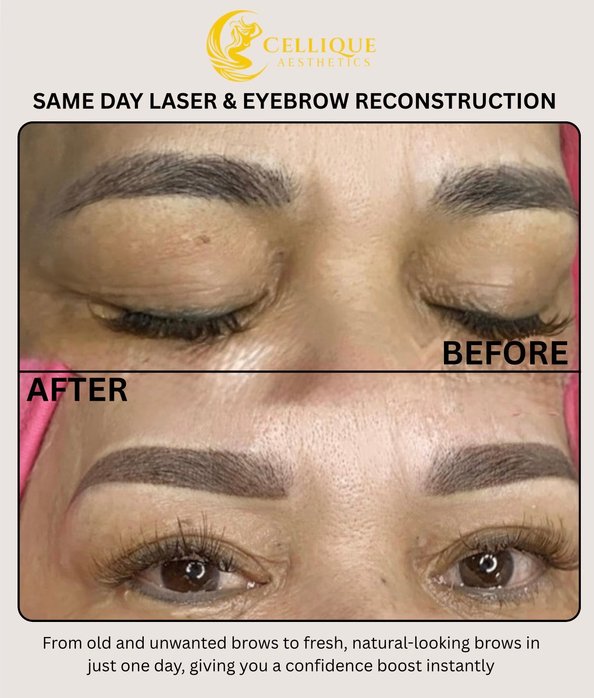 Same Day Laser and Brow Reconstruction