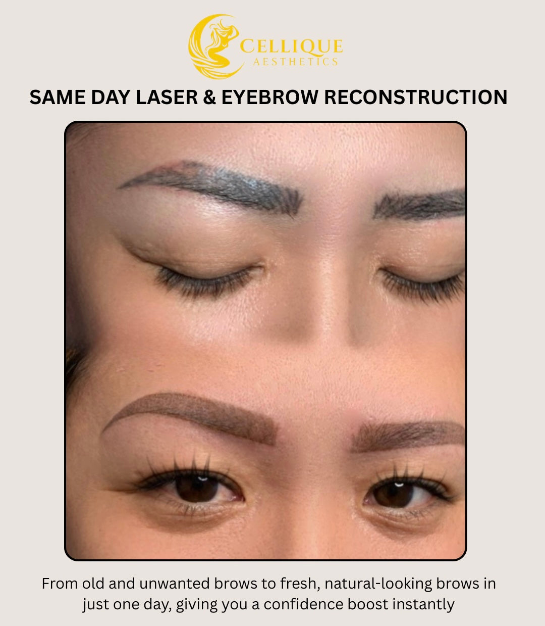 Same Day Laser and Brow Reconstruction
