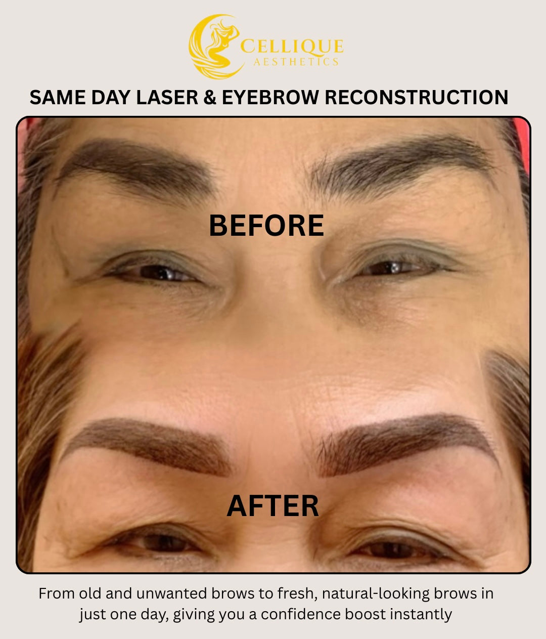 Same Day Laser and Brow Reconstruction