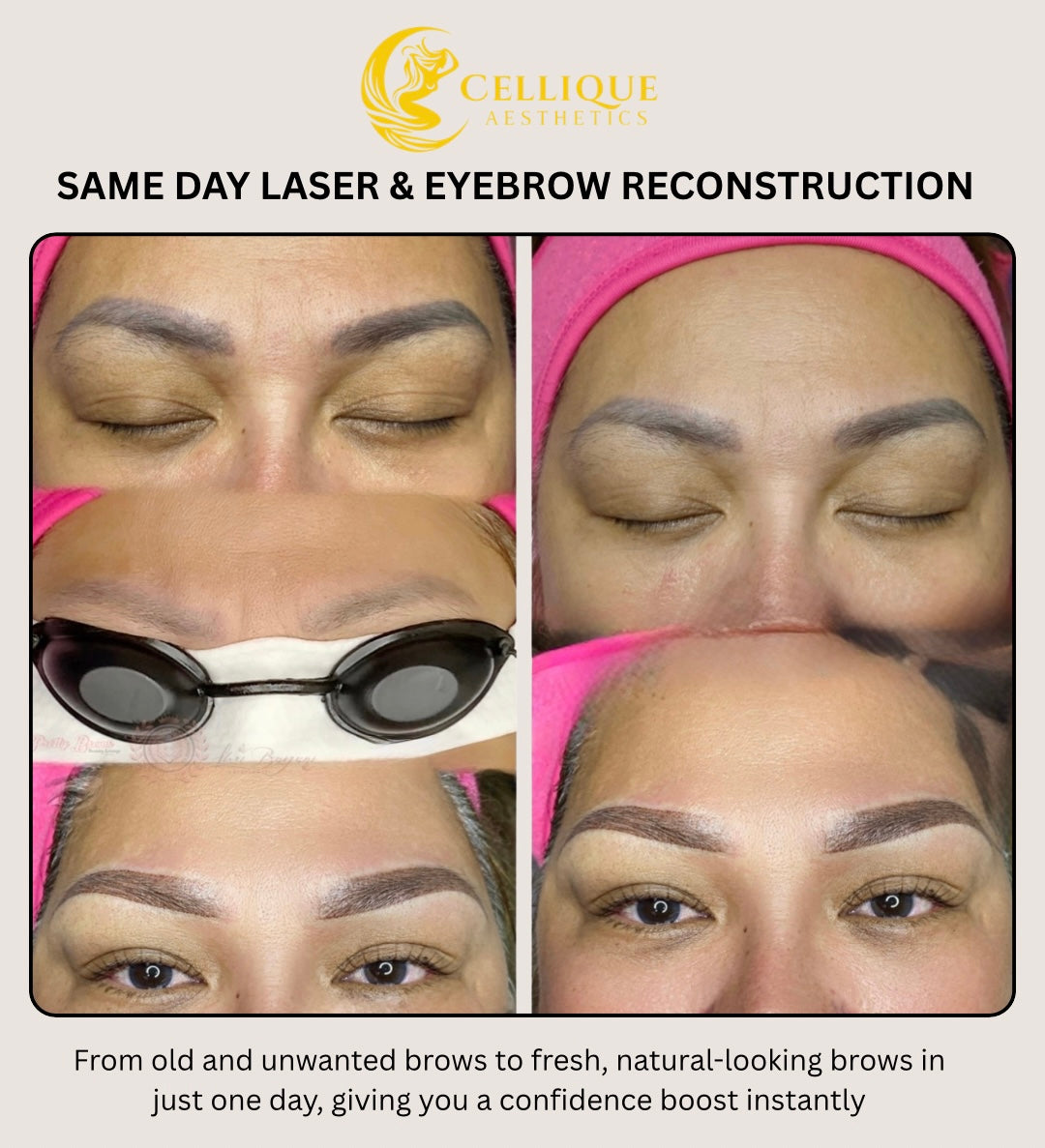 Same Day Laser and Brow Reconstruction