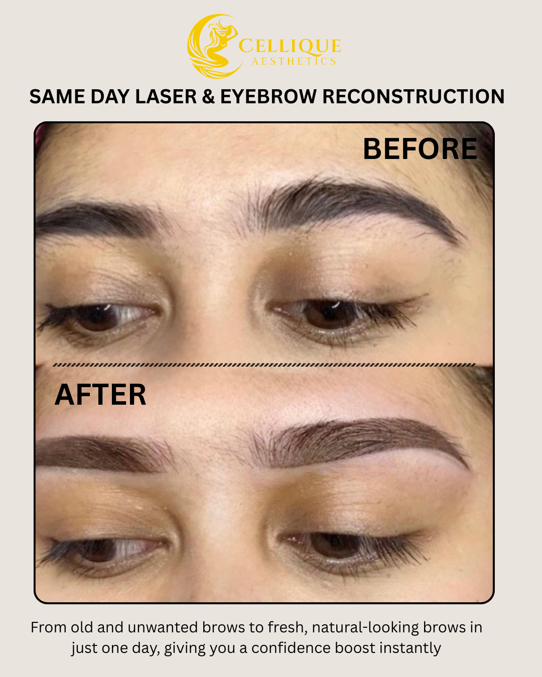 Same Day Laser and Brow Reconstruction