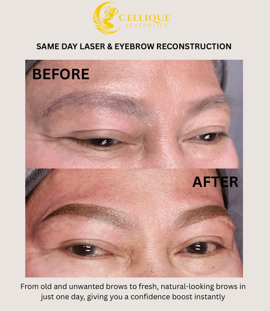 Same Day Laser and Brow Reconstruction